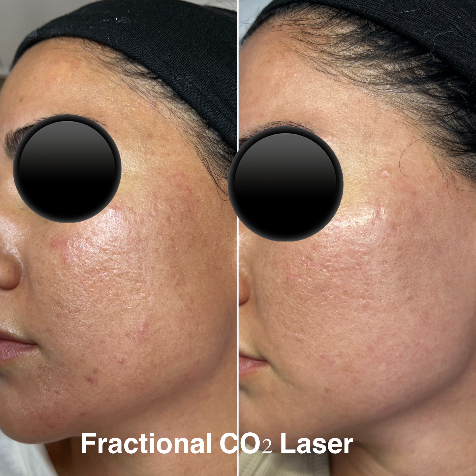 Before and after Fractional CO2 Laser treatment, cheek area