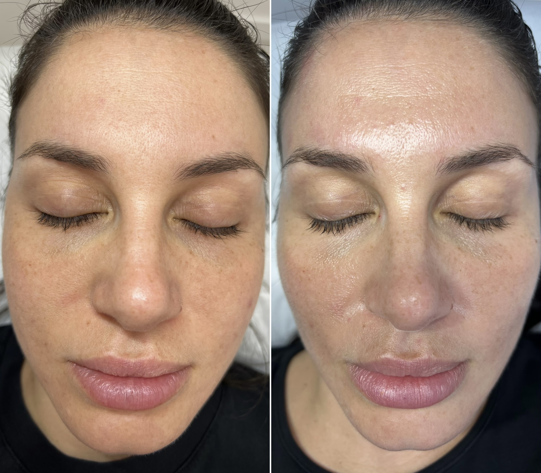 Before and after Fractional CO2 Laser treatment, full face