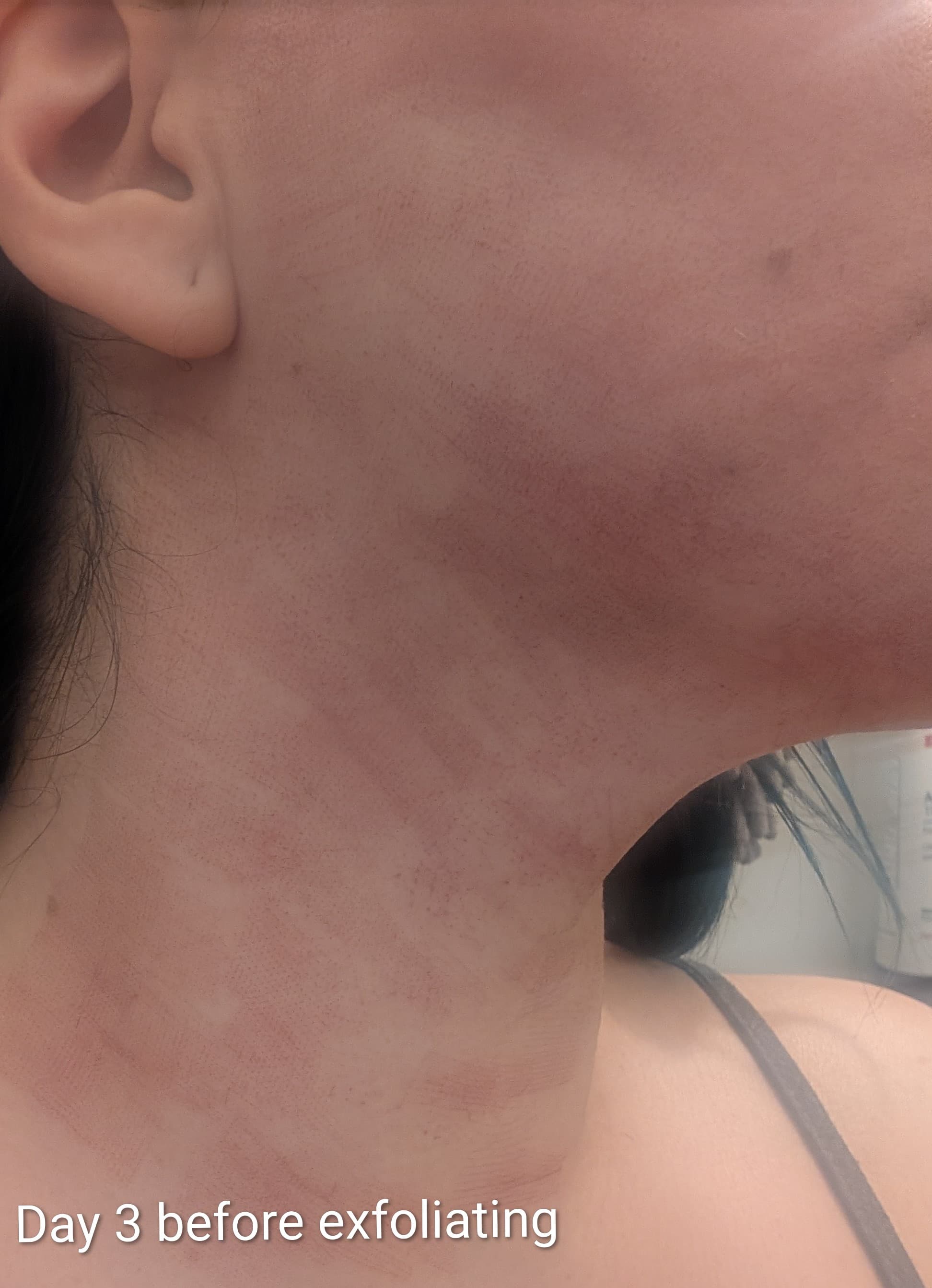 Neck skin three days after Fractional CO2 Laser treatment, before exfoliating